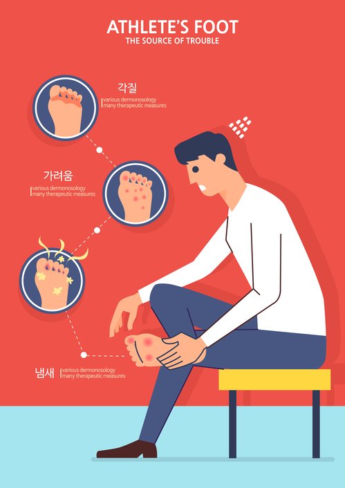 곰팡이균 중 하나인 무좀 생기지 않게 하려면? (사진 5)