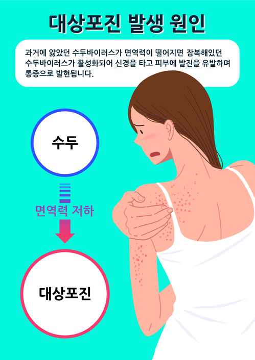 통증까지 발생하는 '대상포진' 치료 및 예방법 (사진 2)