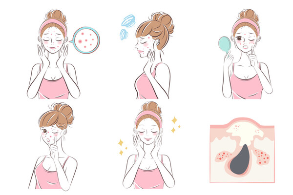 여드름 발생 원인과 치료방법 (사진 3)